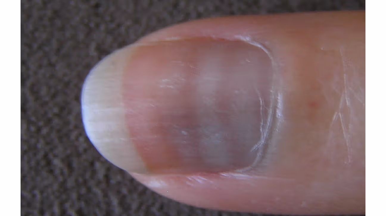 24. Changes in Nail Appearance