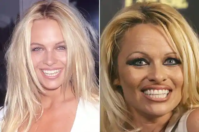 Pamela Anderson – Drug Dependence