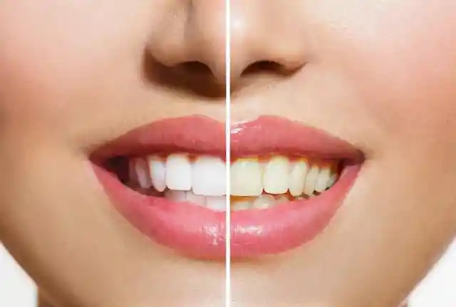 Are White Teeth Healthy Teeth?