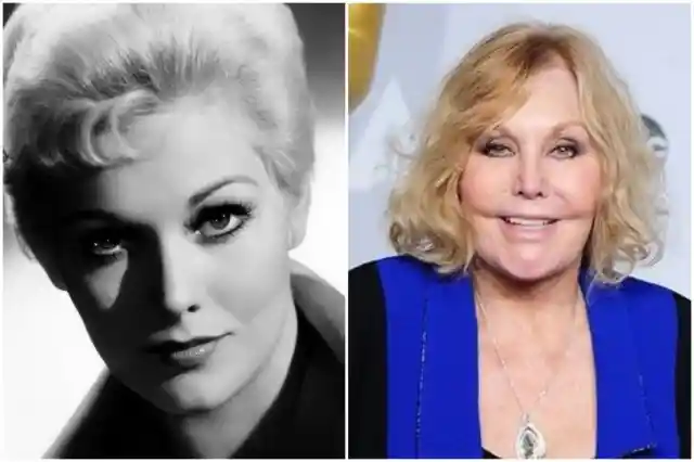 Kim Novak – Botox Treatment