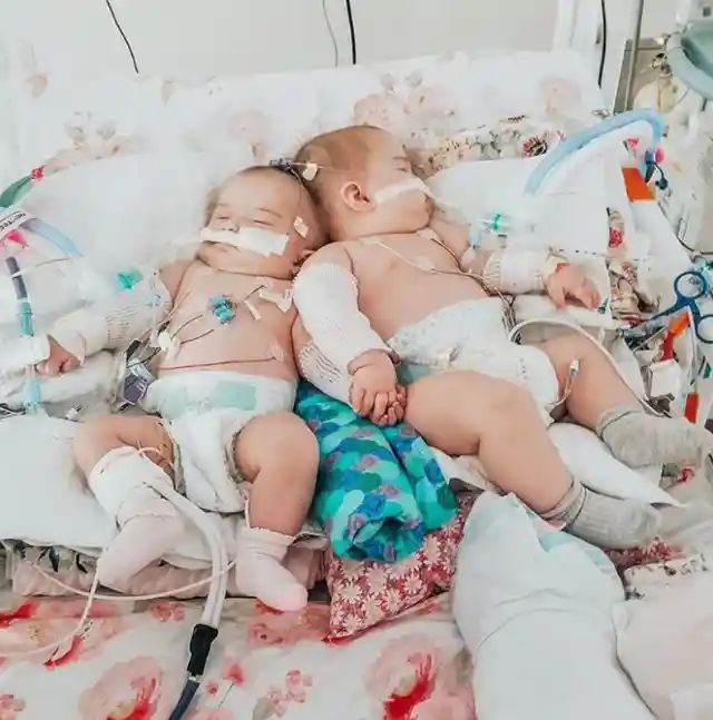Head-to-Head Conjoined Twins Separated in Miracle Surgery