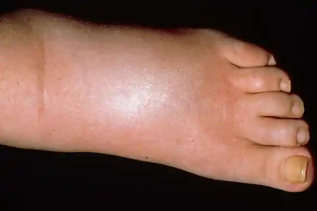 22. Persistent Leg and Foot Swelling