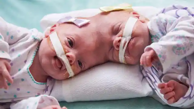 Head-to-Head Conjoined Twins Separated in Miracle Surgery