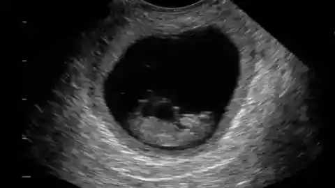 A Positive Ultrasound