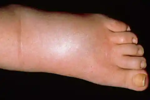 22. Persistent Leg and Foot Swelling